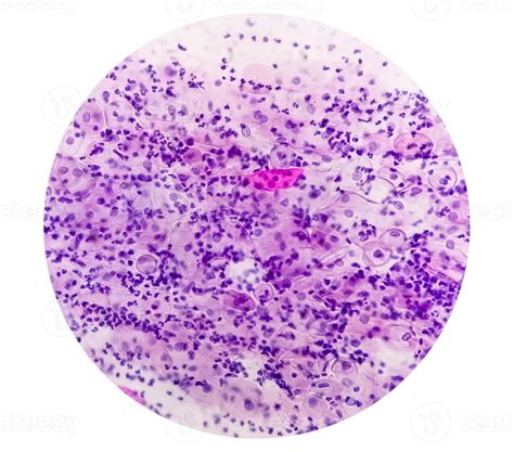 atrophic pattern pap smear|Understanding Pap Smear Results – What They Really Mean.